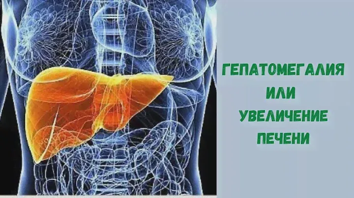 Гепатомегалия или увеличение печени.