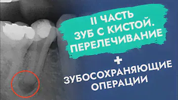 Зуб с кистой. Перелечивание + зубосохраняющие операции.